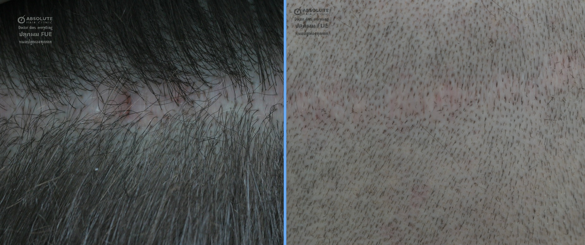 FUE hair transplant in scar